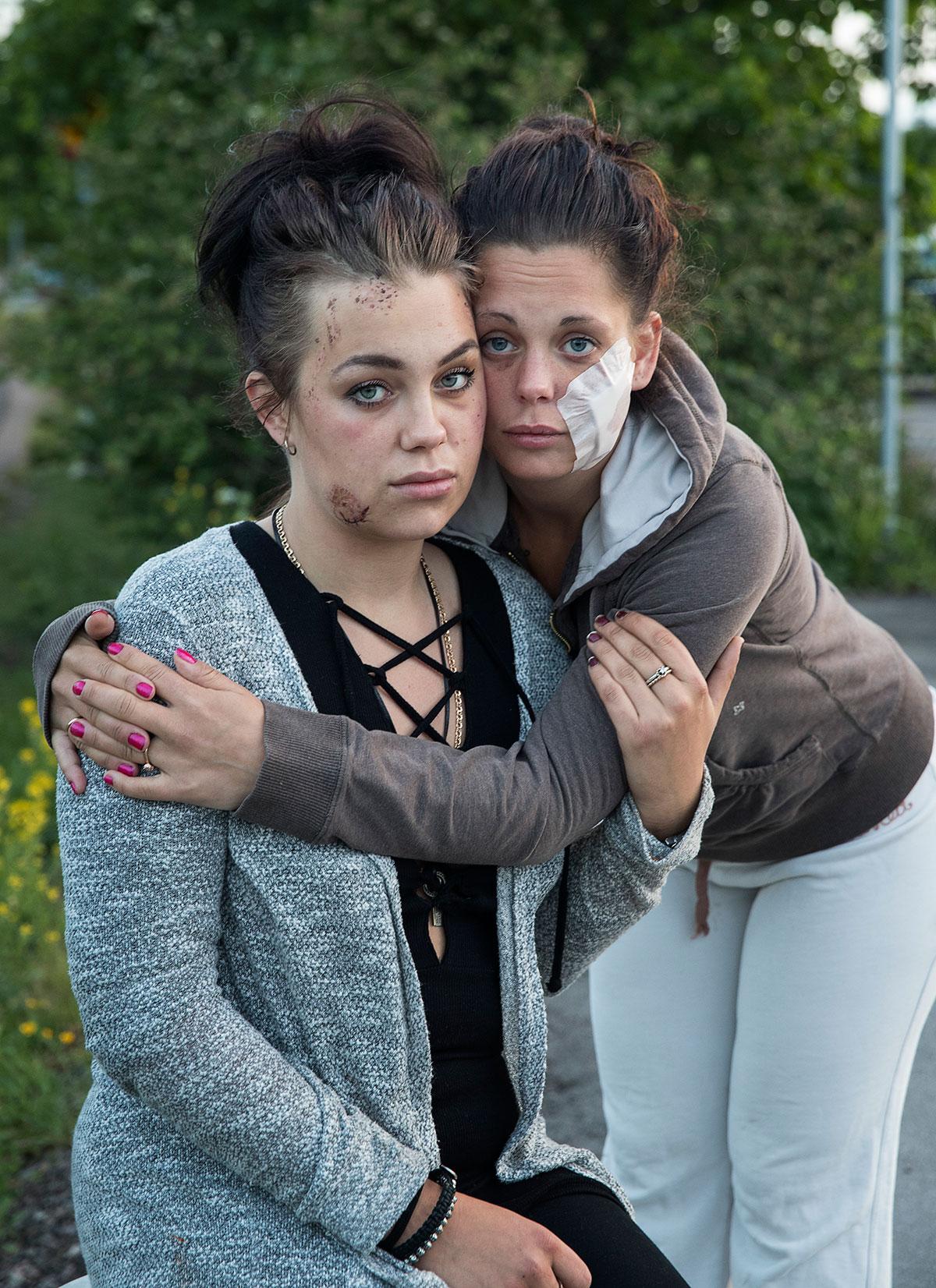 Josefine och Danielle Siljebäck (plåster), som fått ansiktena delvis bortbitna.