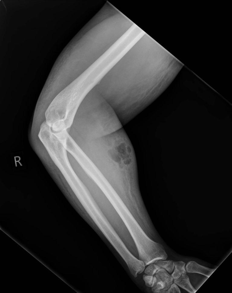 Röntgenbilden visar ansamling av vätska.