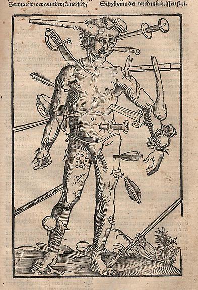 Ur Hans von Gersdorffs ”Fälthandbok om sårade” (1517).