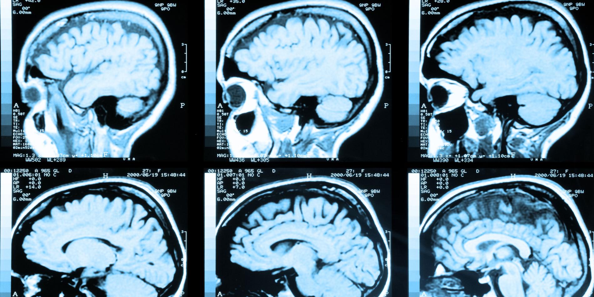Ny studie visar – så mycket åldras din hjärna av cannabis. (Bilden har inget med studien att göra)