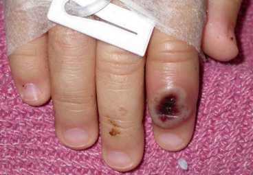 drabbad Handen på ett barn som smittades av en präriehund.