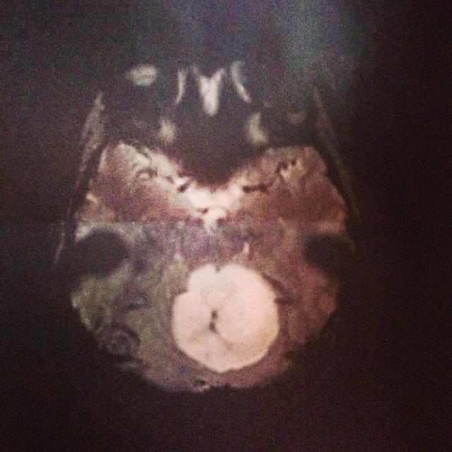 Röntgenbild på tumören i Fridas hjärna. Foto: Privat