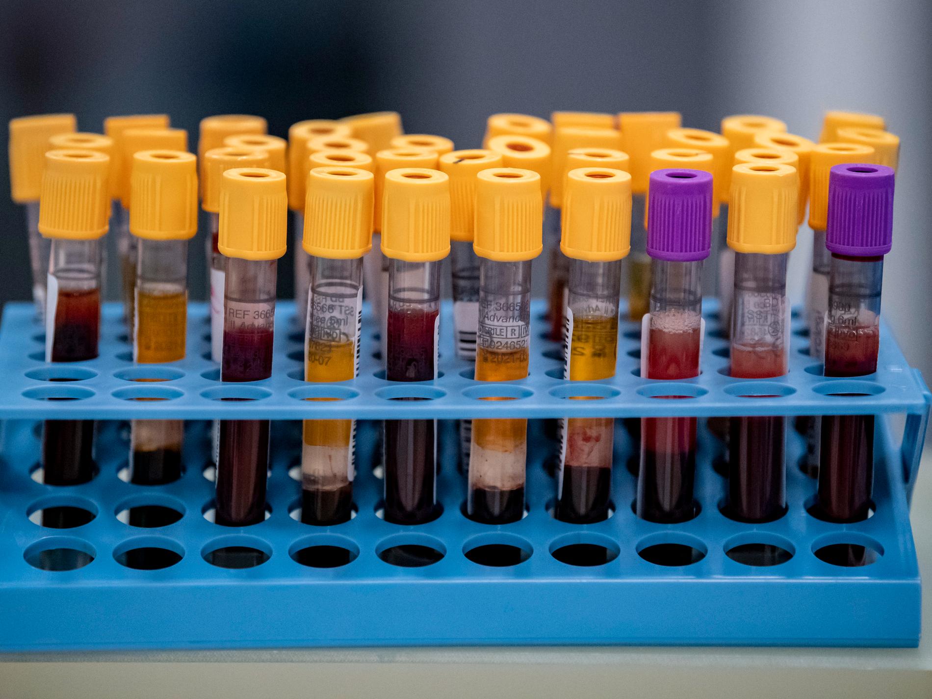 Nytt blodprov kan avslöja tolv cancerformer