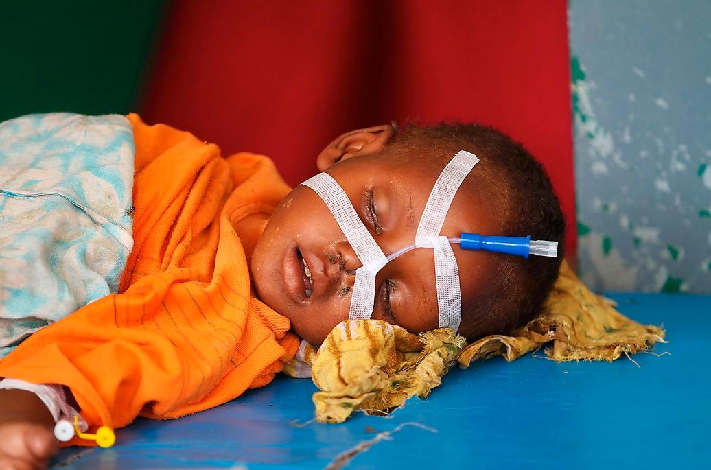 AKUT Den svårt undernärda bebisen sover på sjukhuset Banadir i Somalias huvudstad Mogadishu. Mönstret upprepar sig, omvärldens reaktioner kommer aldrig i tid.
