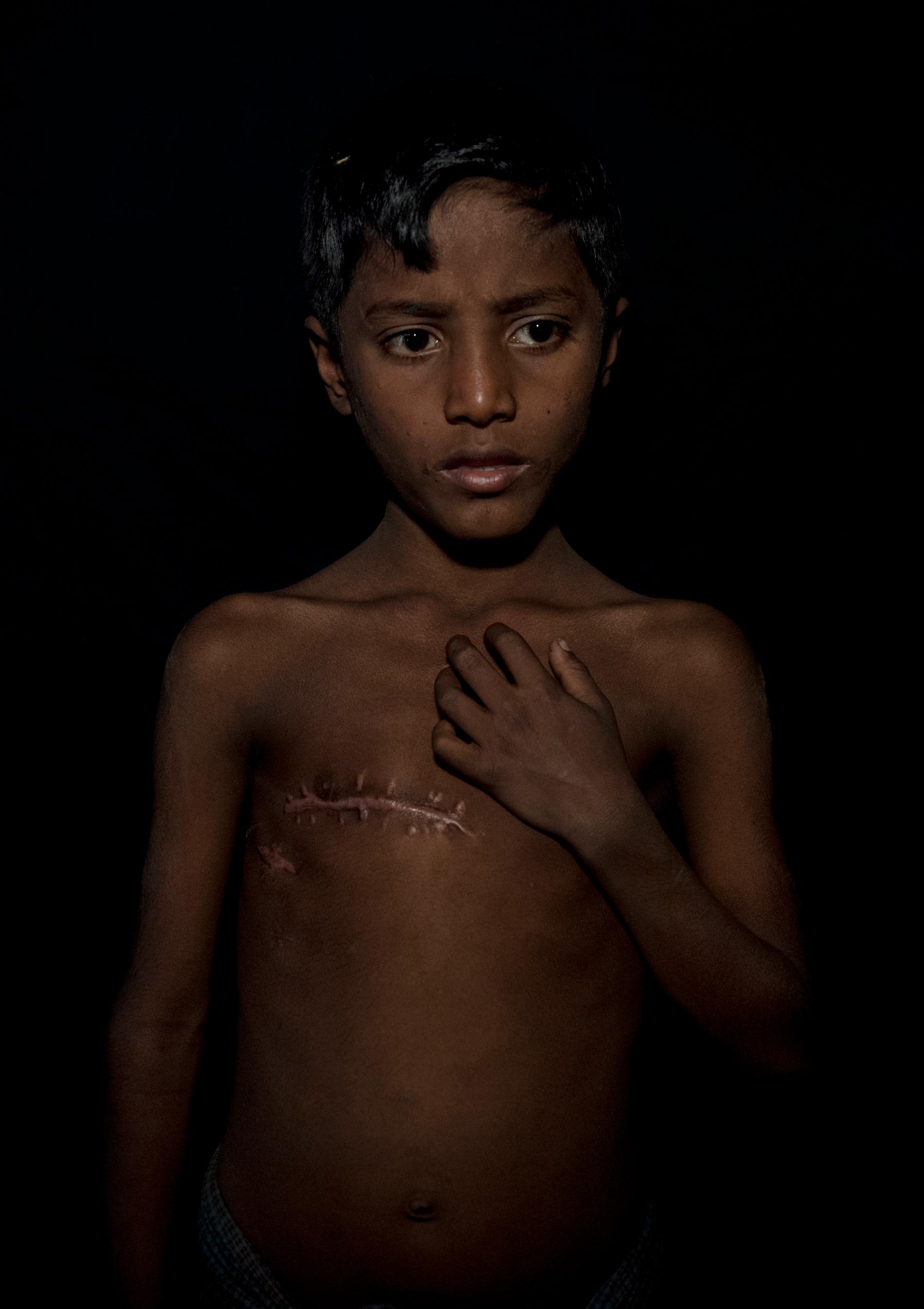 2:a pris i kategorin Porträtt Andreas Bardell, Södra Bangladesh är överfullt av flyktingläger, där den statslösa muslimska minoritetsgruppen rohingya har sökt skydd från den burmesiska militärens våld och fördrivning. De berättar skräckhistorier om våld, tortyr och död. Sjuåringen Mohammad Johaid blev skjuten. Han tycker illa om märket som sträcker sig från ryggen till bröstet, där kulan plockats ut.? Jag blir ledsen när jag tittar på det. Jag minns att jag var rädd för att dö, säger han. Motivering: Avskalat, intensivt, effektivt. Skottsåret och blicken? mer behövs inte för att förstå den unge rohingyern Mohammads hemska upplevelser.
