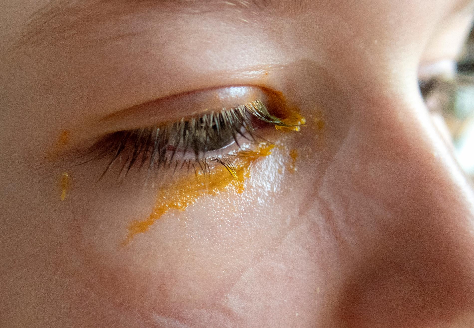 Huskur vid ögoninflammation: Tvätta ögonen med ljummet vatten och byt örngott varje dag. Låt barnet ha en egen handduk så att smittan inte sprids.