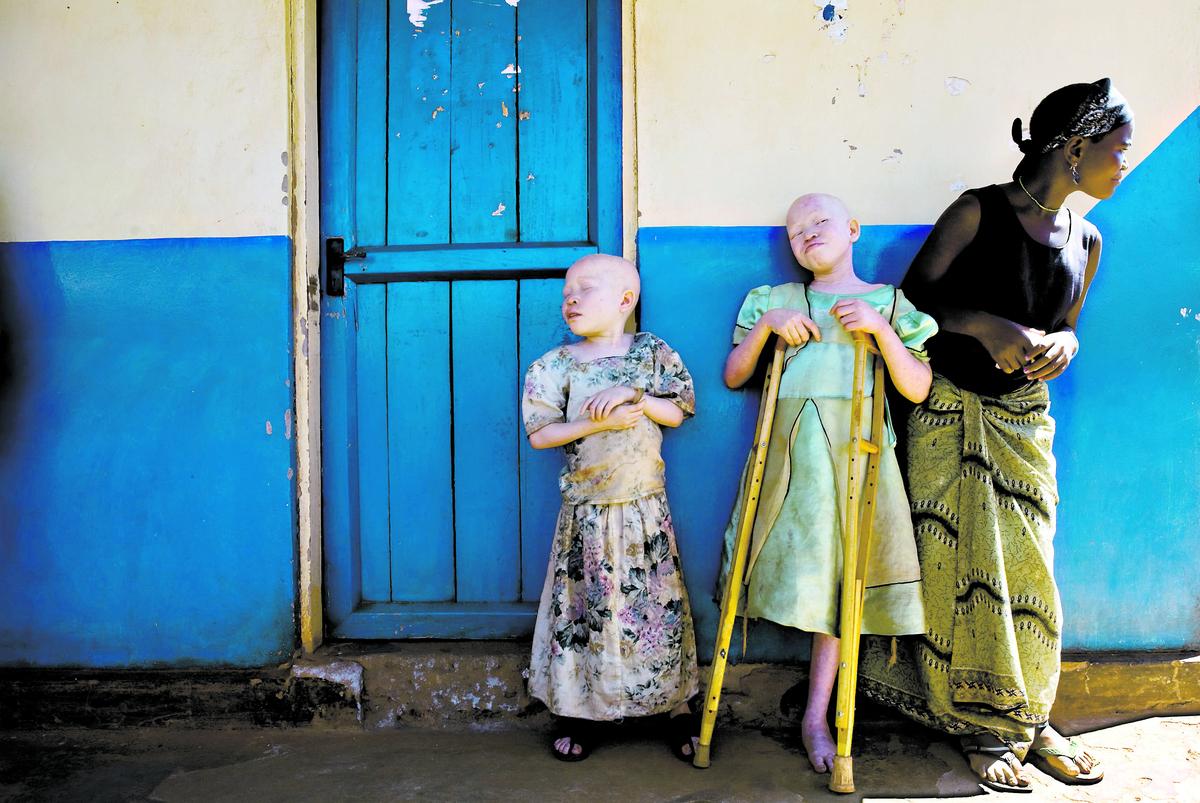 Attacker mot albino-personer är vanliga i Tanzania. Här en flicka som 2011 fick ena benet avhugget.