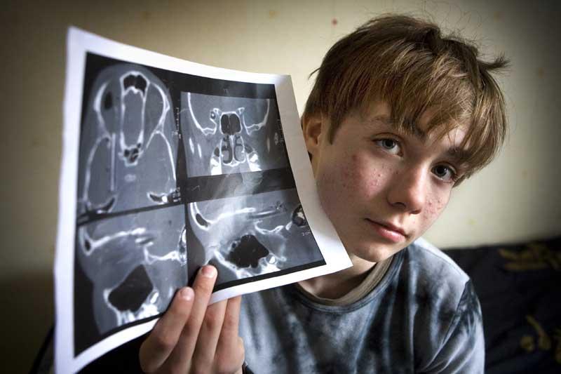 13-årige Jimmy Pettersson snubblade och blyertspennan han höll i handen trängde in bakom ögat och in i hjärnan.