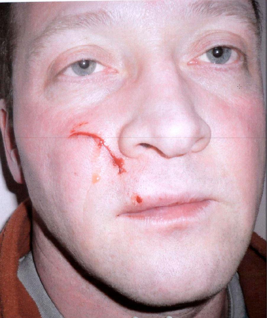 Bild på Niklas Lindgren efter misshandeln. Två livstidsdömda mördare dömdes för att ha misshandlat honom i fängelset.