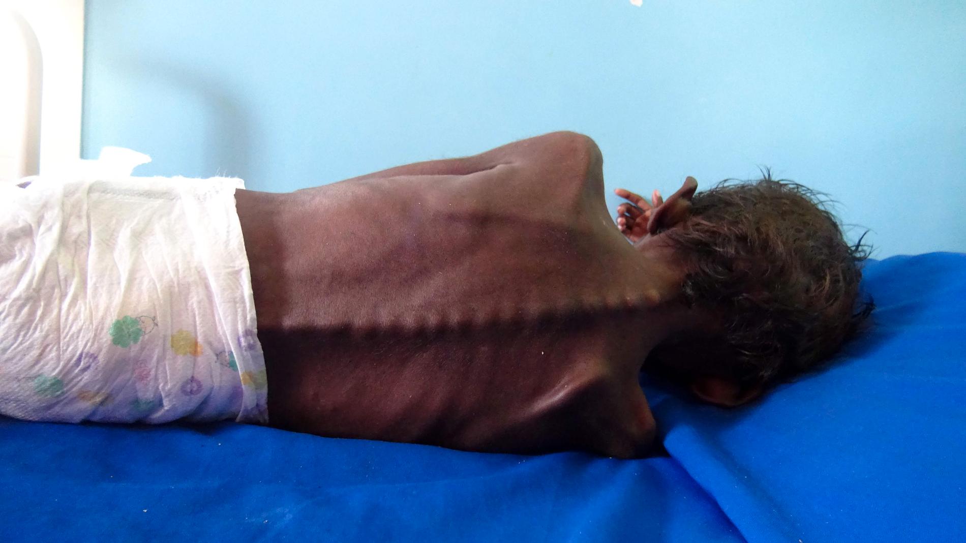 En femårig pojke vilar på en säng på ett sjukhus i staden al-Hudaydah i västra Jemen. Pojken lider av allvarlig undernäring och väger bara fem kilo. Arkivbild.