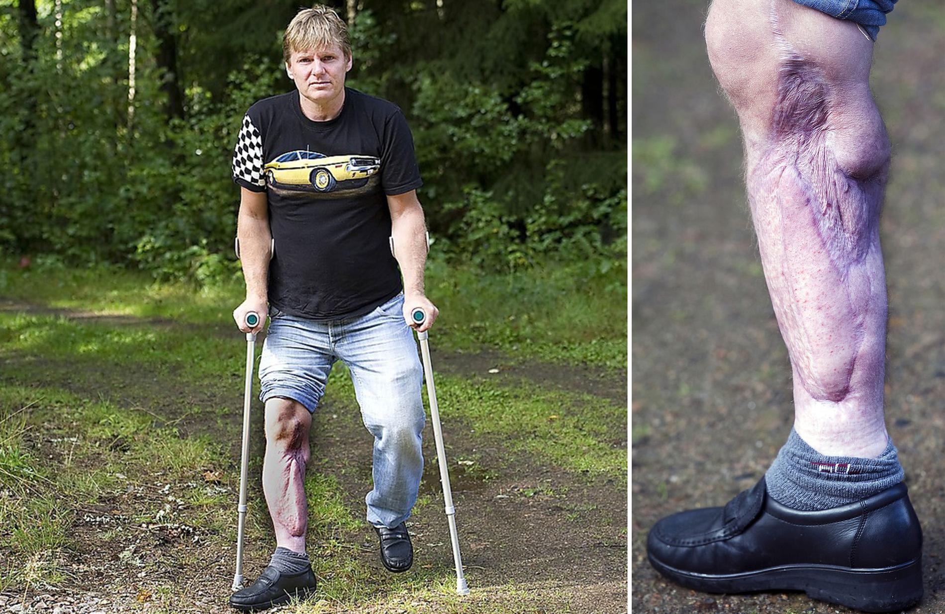 ”VIKTIGT ATT INGRIPA NÄR NÅGOT ÄR FEL” Trots att Tonny Sjödahl, 44, har tvingats till operation av sitt skadade ben 15 gånger har hans syn på civilkurage inte förändrats.