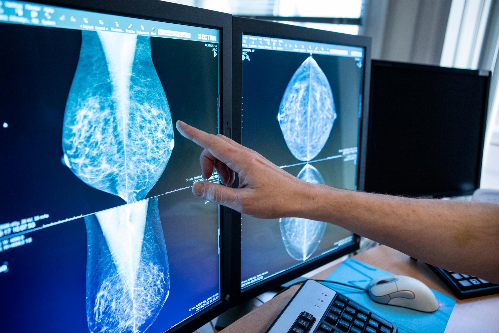 I dag screenas kvinnor för bröstcancer med vanlig 2D-mammografi. Men om alla skulle screenas med 3D skulle fler fall av intervallcancer hittas tidigare, visar en ny svensk studie.