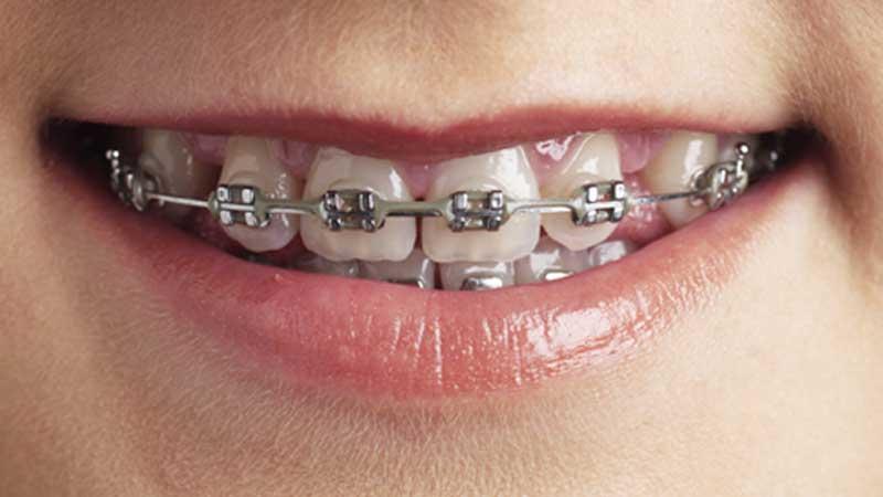 En fast tandställning är dubbelt så effektiv som en avtagbar.