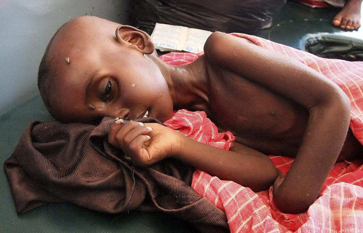 BEHÖVER HJÄLP  Situationen på Afrikas horn är fortfarande mycket svår. Mer än 11 miljoner människor beräknas vara i behov av mat och läkarvård i den värsta svältkatastrofen som drabbat området på 60 år. Farhiya Abdulkadir, 5, vårdas på ett sjukhus i Mogadishu i södra Somalia.