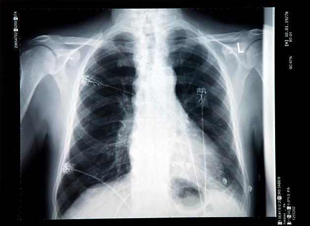 Röntgenplåten är från ett annat tillfälle och föreställer inte 72-åringens lungor.