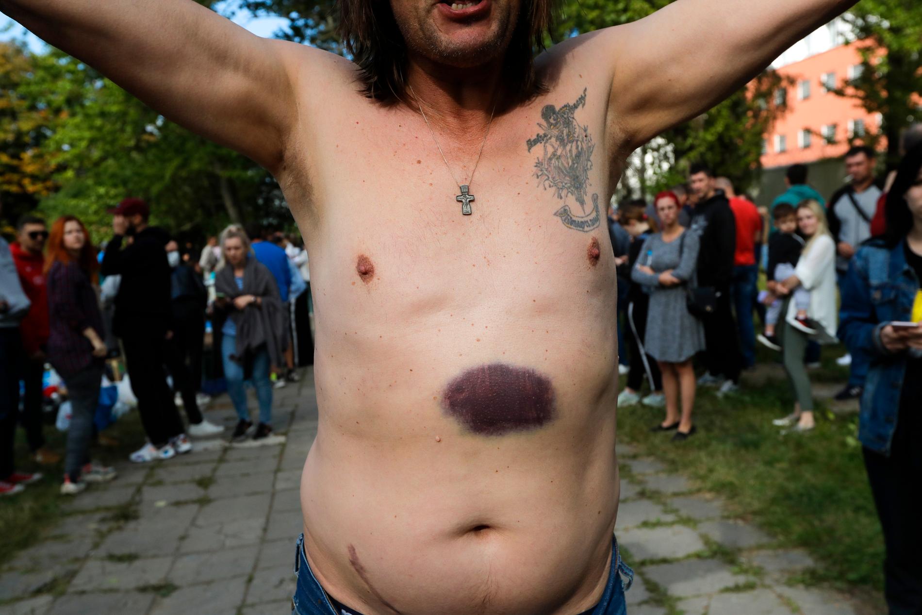 En av demonstranterna visar upp skador han har fått i häktet i Minsk.