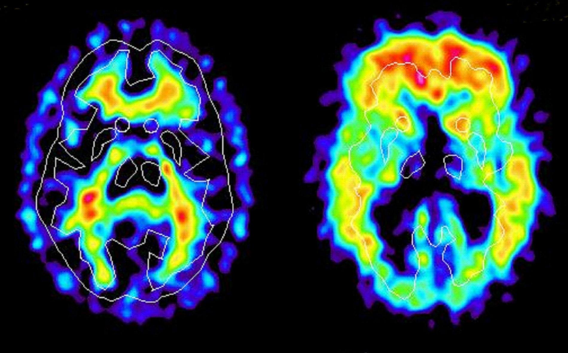 Bilder på de proteinklumpar – amyloida plack – som bildas i hjärnan vid Alzheimers sjukdom. Arkivbild.