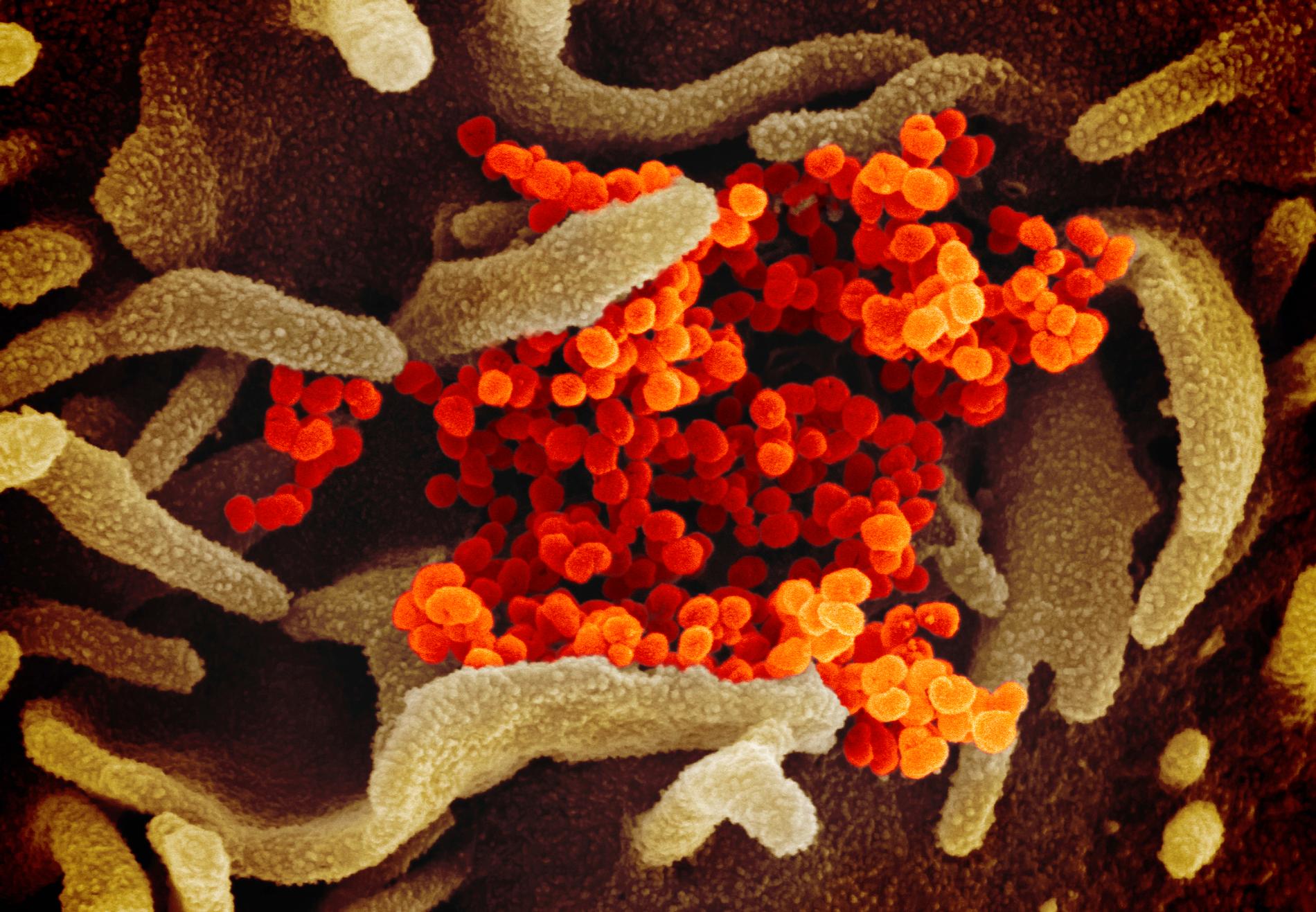 Det nya viruset SARS-CoV-2 (orange färg) som orsaker influensaliknande sjukdomen covid-19.  På tisdagen bekräftades att även Skåne drabbats.