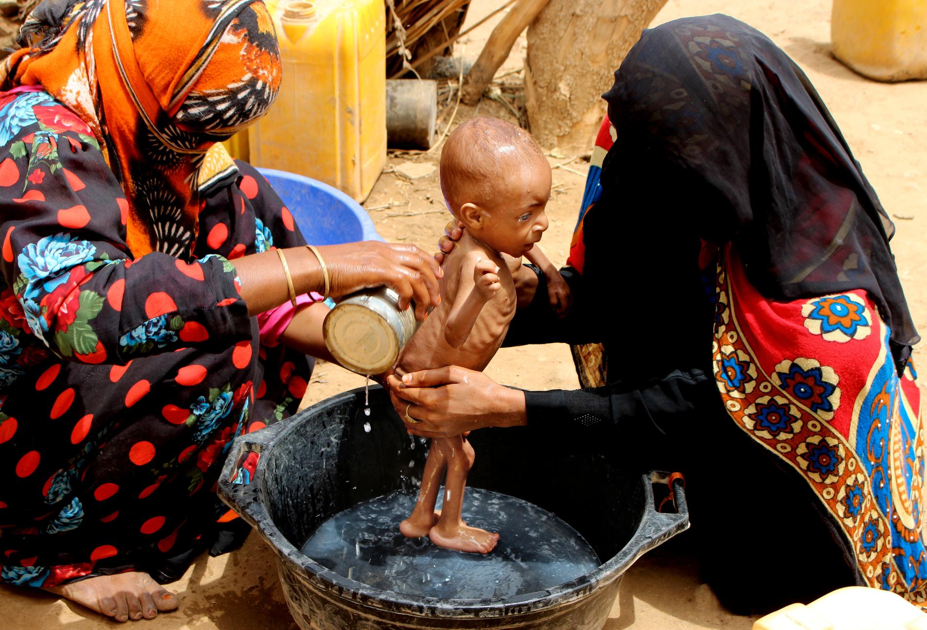 Ett svårt undernärt spädbarn pysslas om i provinsen Hajjah i västra Jemen. Kriget i landet har slagit sönder det fattiga landets förmåga att försörja sin befolkning och miljontals människor hotas av svält. Arkivbild.