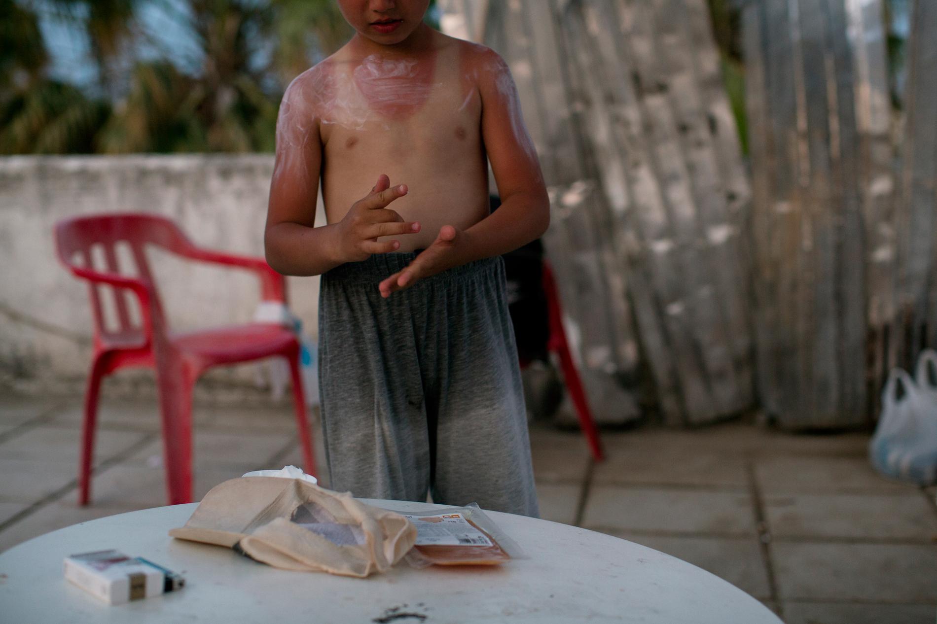 9-åriga Adnan har bränt sig i solen. Han och hans far Osama har funnit en plats att bo, uppe på flyktingförläggningens tak. Foto: Johan Persson