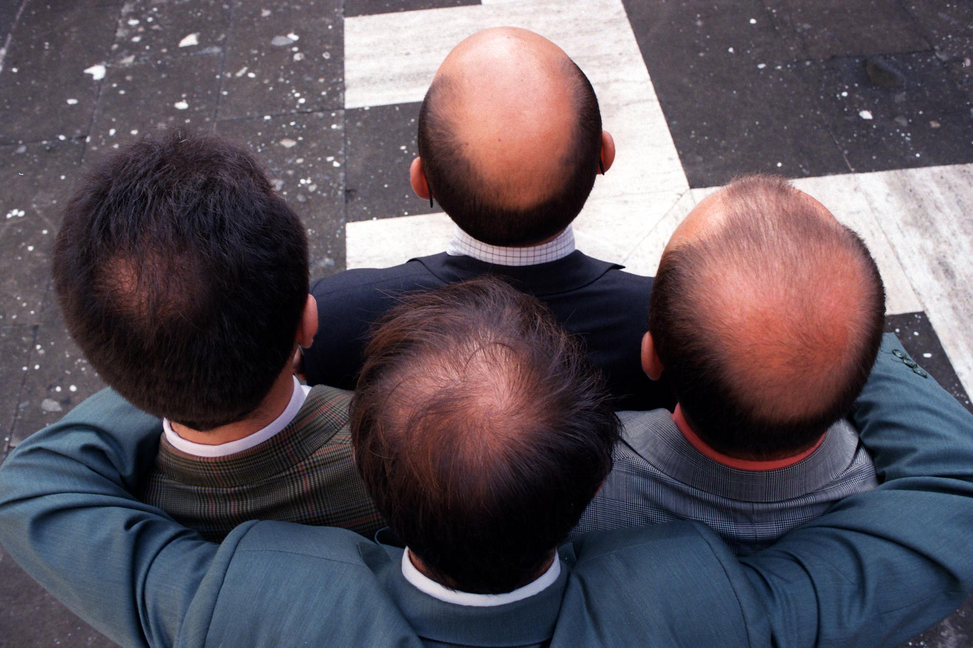 Forskarna bakom studien såg ett samband mellan de som jobbade övertid och håravfall.