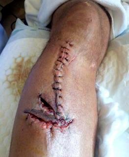 Efter operationen i Thailand såg Joakims ben ut så här. På flyget sprack stygnen.