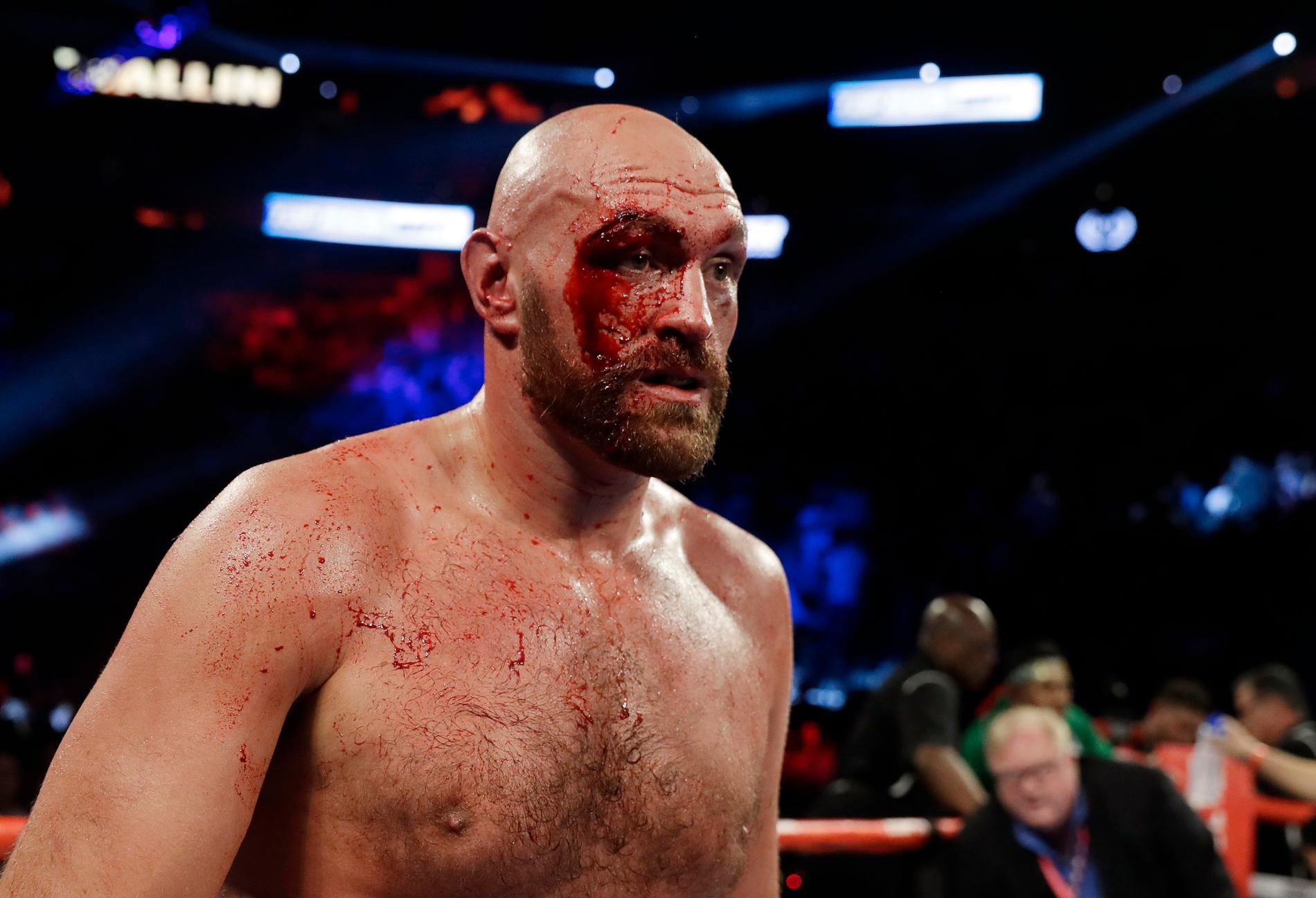 Tyson Fury blodig efter matchen