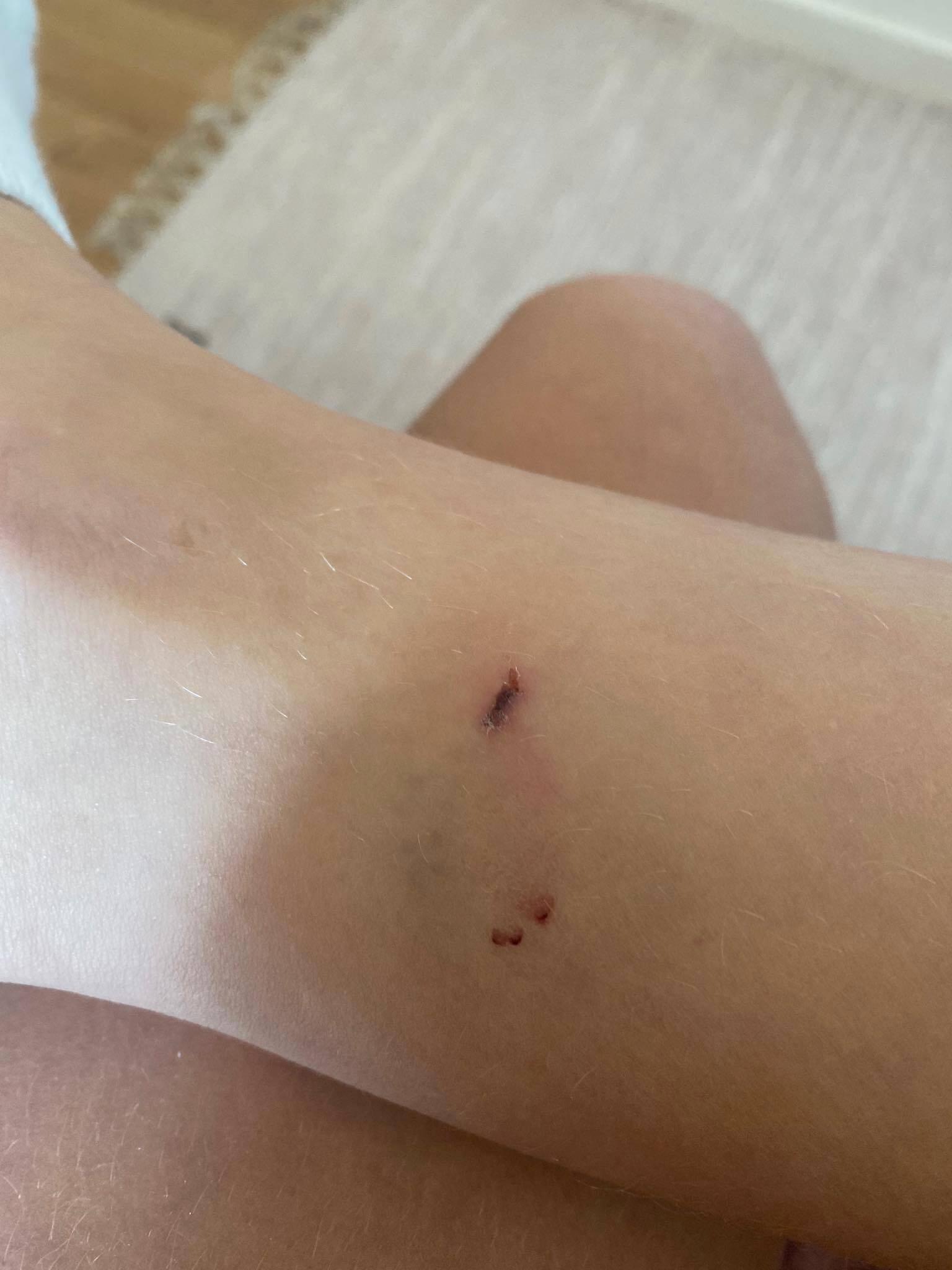 ”Man kan se märken från råttänderna”, säger Jennifer Mikkelsen om såren på benet.