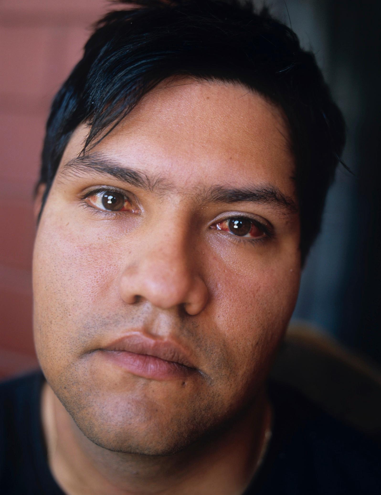 Elvis Rojas Rojas får njursten minst en gång om året, han lider också bland annat av högt blodtryck, så pass att hans ögon fylls med blod.