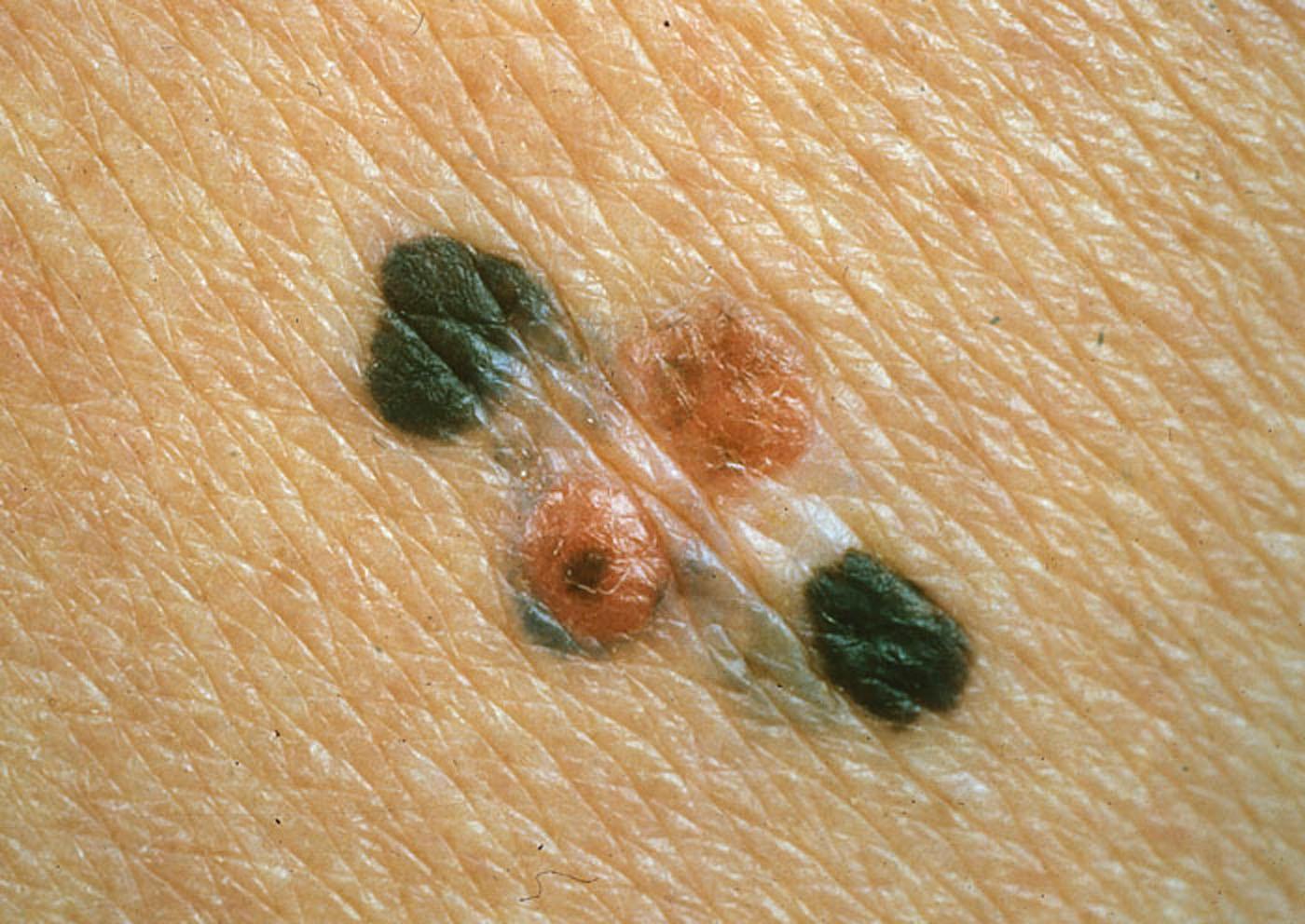 Det finns tre olika sorters hudcancer, detta är ett exempel på Malingt melanom.