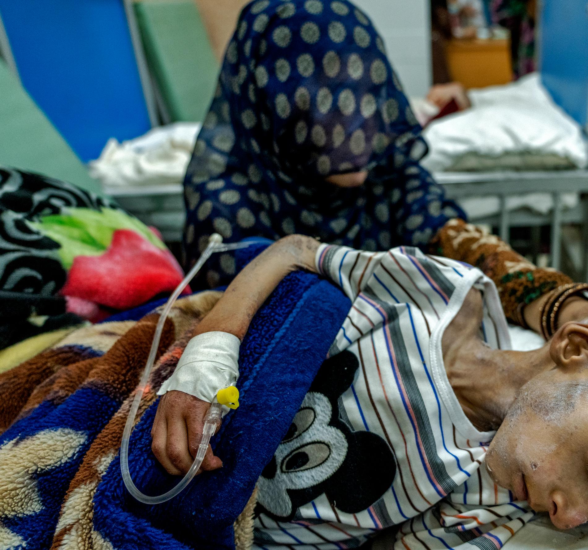 Allt fler barn i Afghanistan drabbas av undernäring. Här får en undernärd pojke vård på Indira Gandhi hospital i Kabul. I slutet av året väntas 1,1 miljoner barn under 5 år lida av undernäring till följd av klimatförändringar och minskat stöd från omvärlden. 