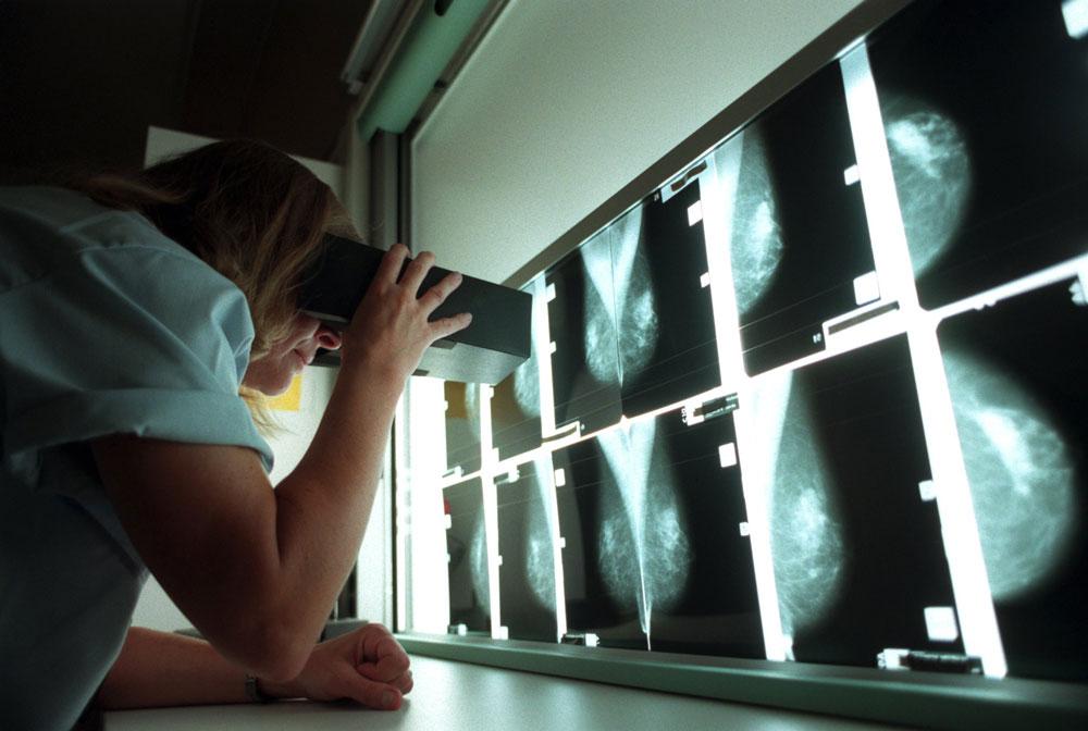 Gunilla Svane på Radiumhemmets mammografienhet, Karolinska sjukhuset, tittar på en av de tusentals röntgenplåtar som fotograferas varje år. Plåtarna visar friska bröst.