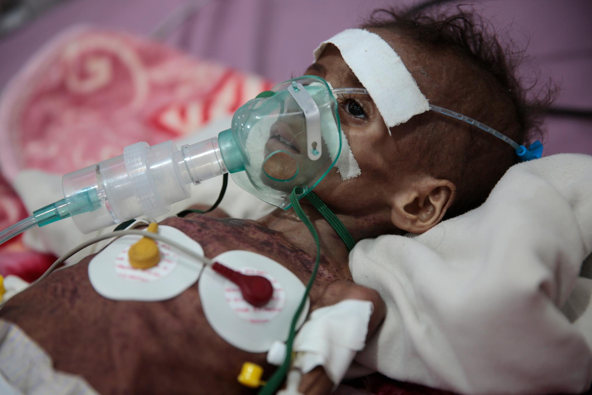 Den undernärda flickan Rahmah Watheeq vårdas på sjukhus i Sanaa. Bilden är från november.