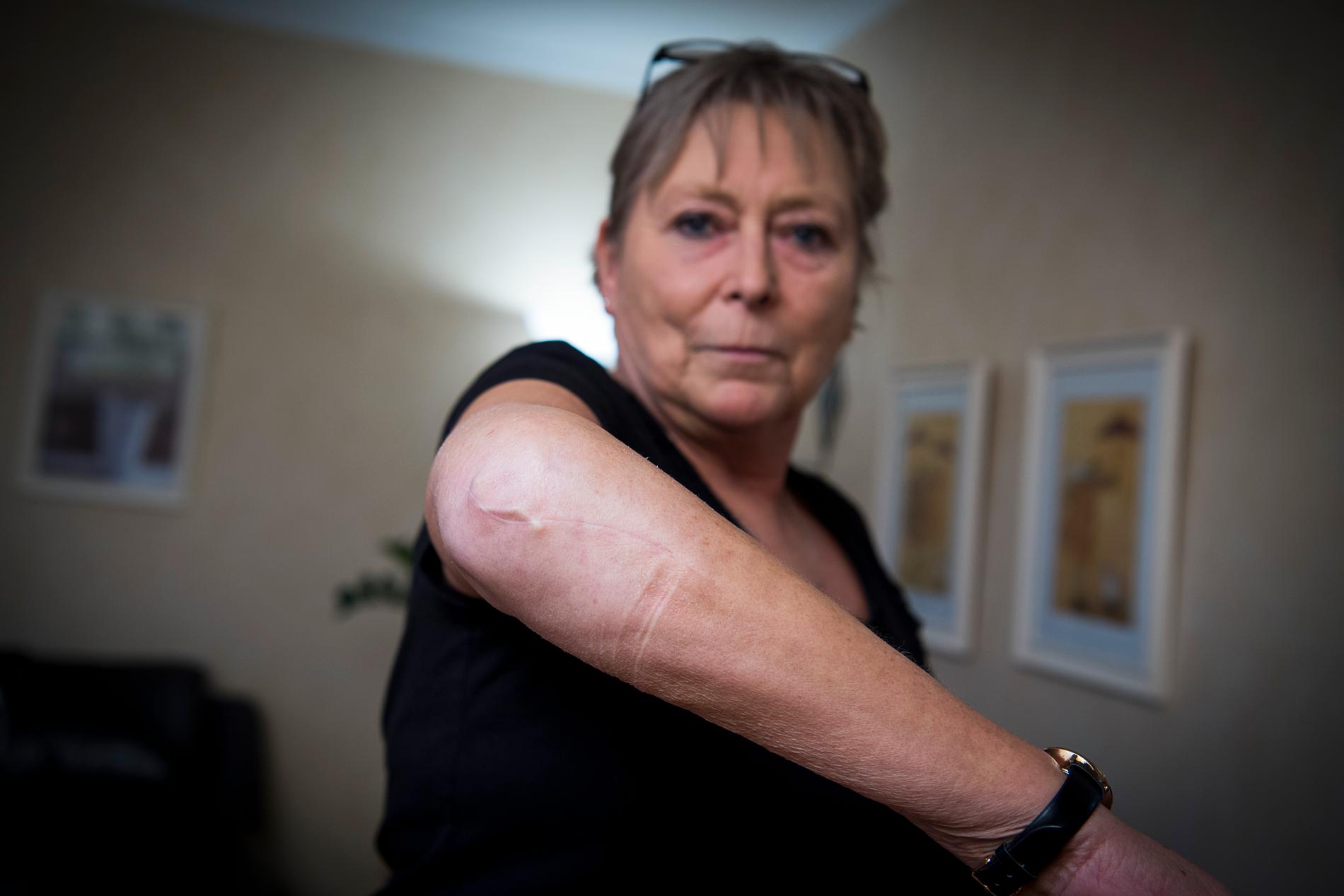 Maritas armbåge blev krossad under terrorattacken och hon har inopererade plattor och skruvar i armen. 
