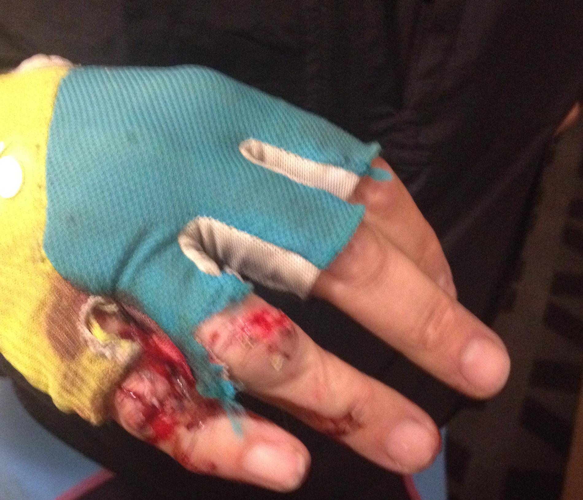 Möllers skadade hand.