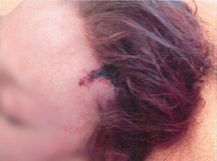 Ex-flickvännen fick ett stort jack i pannan efter slaget med yxan, men överlevde. 