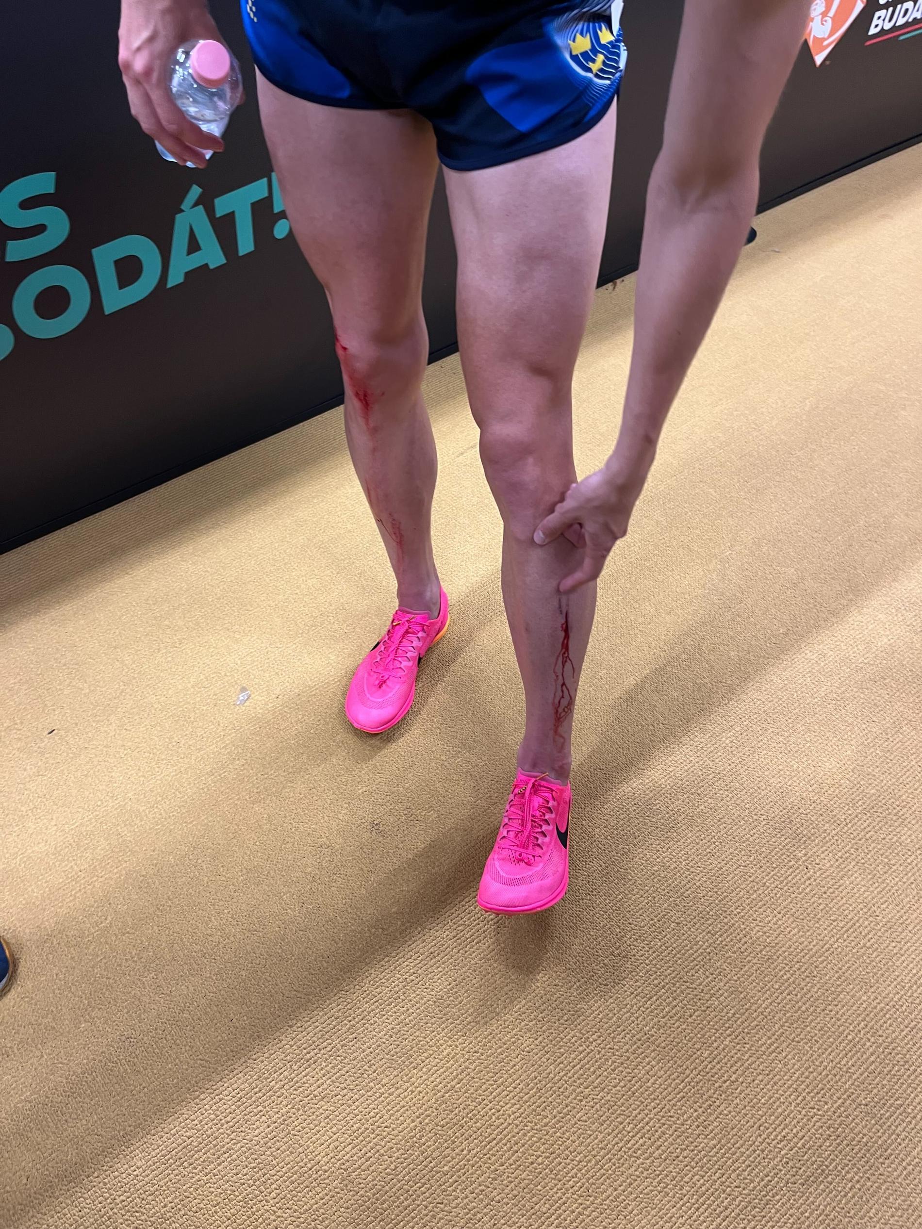 Andreas Almgren visar upp blodiga ben efter loppet.