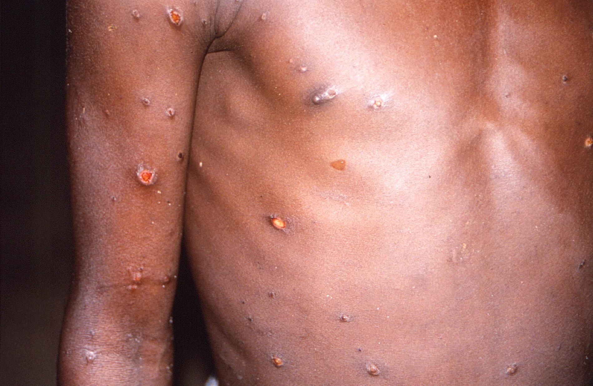 En bild på apkoppor från 1997 som distribuerats av CDC, USA:s motsvarighet till Folkhälsomyndigheten.