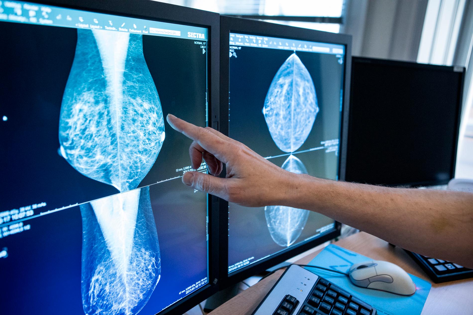Ett implantat skymmer bröstvävnaden till 80 procent, säger Karin Leifland som är verksamhetsområdeschef för bilddiagnostik och onkologi vid Södersjukhuset i Stockholm.