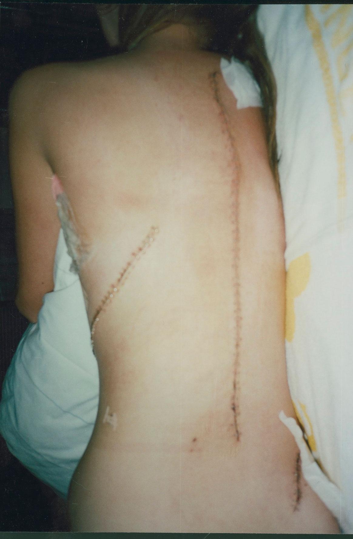 ÅR 2002: Linda, 12, efter sin första steloperation av fem.