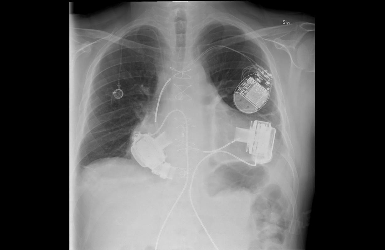 De två pumparna syns på var sin sida av hjärtat. Dosan uppe till höger på bilden är en inopererad defibrillator som Emil har haft sedan tidigare och som ligger kvar under huden nedanför nyckelbenet även om den inte behövs längre.