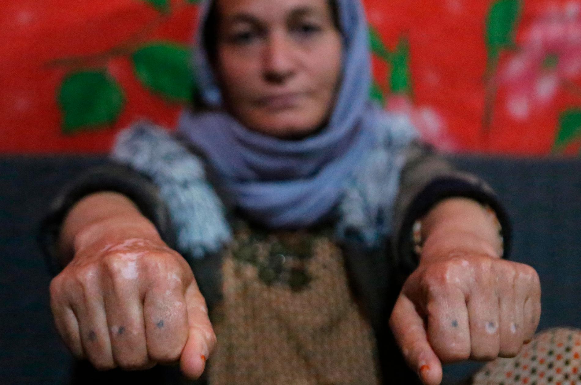 Baseh Hammo är en av många yazidiska kvinnor som utsatts för IS våld. Skadorna på hennes händer fick hon när en IS-anhängare tvingade henne att trycka knogarna mot kokhet asfalt.