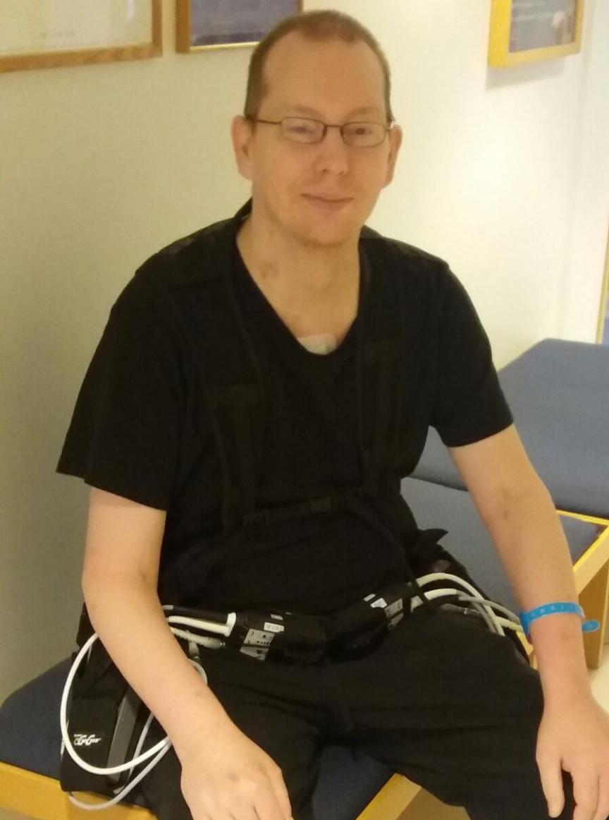 Emil Johansson, 43, lever med tre hjärtan men ingen puls – det är han först med i Norden.