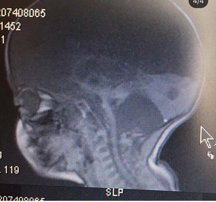 En stor del av Eltons hjärna tillbakabildades, något röntgenbilder visar. 