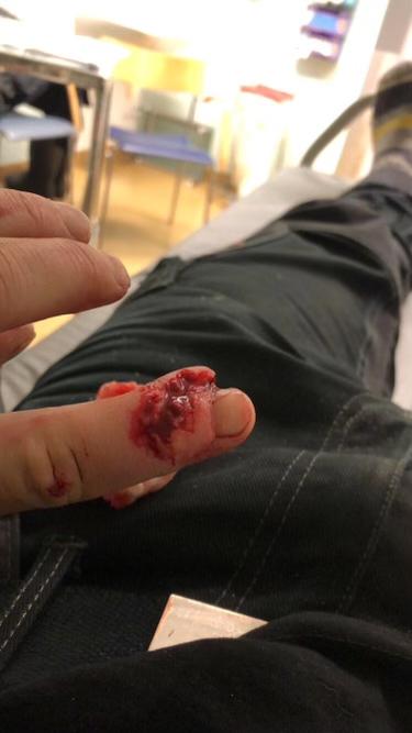 Bild från sjukhuset och det skadade pekfingret.