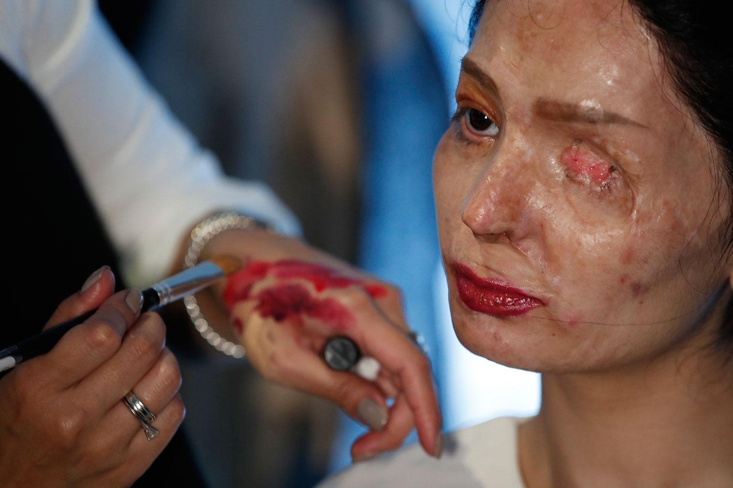 Reshma Bano Quereshi, 19, har förlorat ett öga och har ärrvävnad i hela ansiktet efter en syraattack för två år sedan.