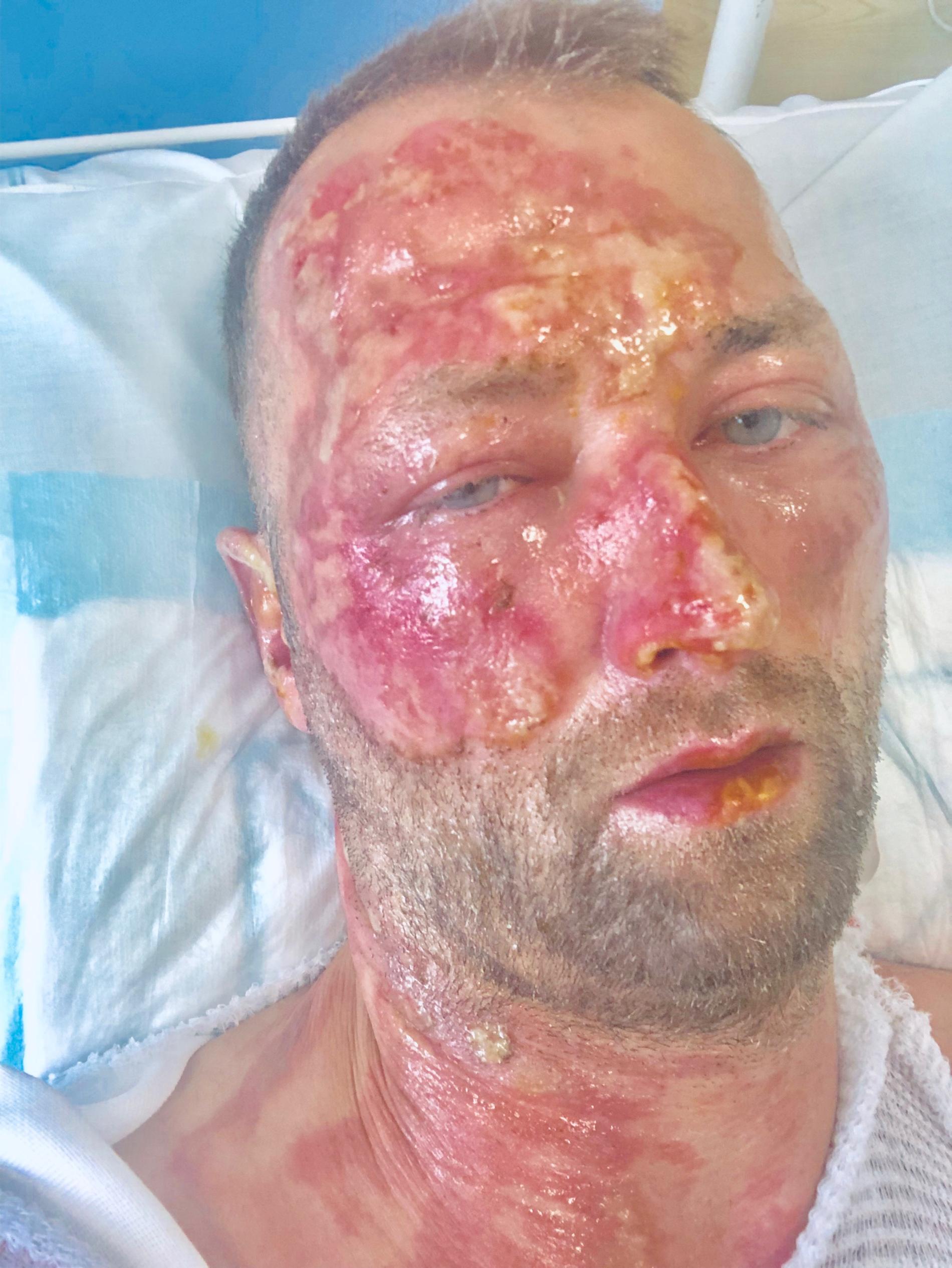 Kristian Huselius, 40, vårdas för brännskador på en intensivvårdsavdelning.