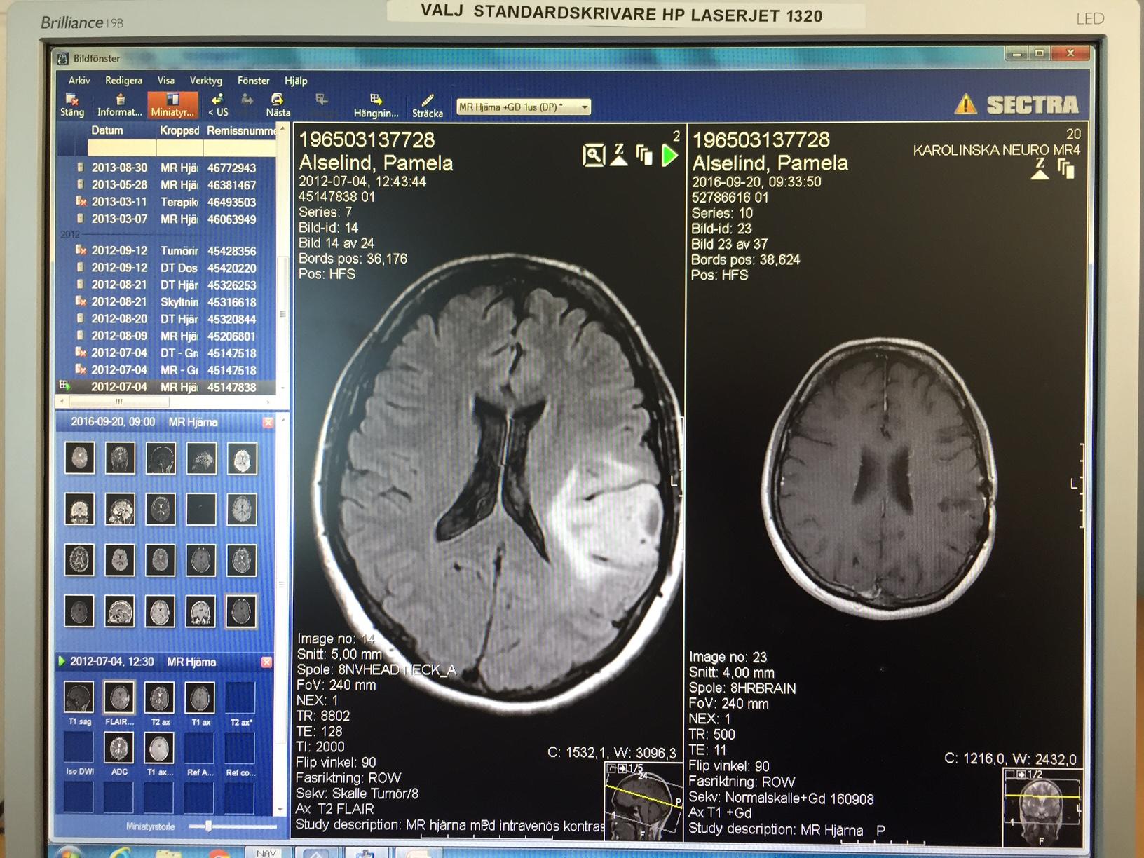 Till vänster syns tumören i Pamelas hjärna när den upptäcktes i juli 2012. Till höger: Den är borta. 
