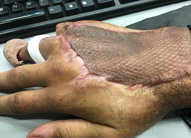 Antoine Boylston fick transplantera hud från låret till handen. 