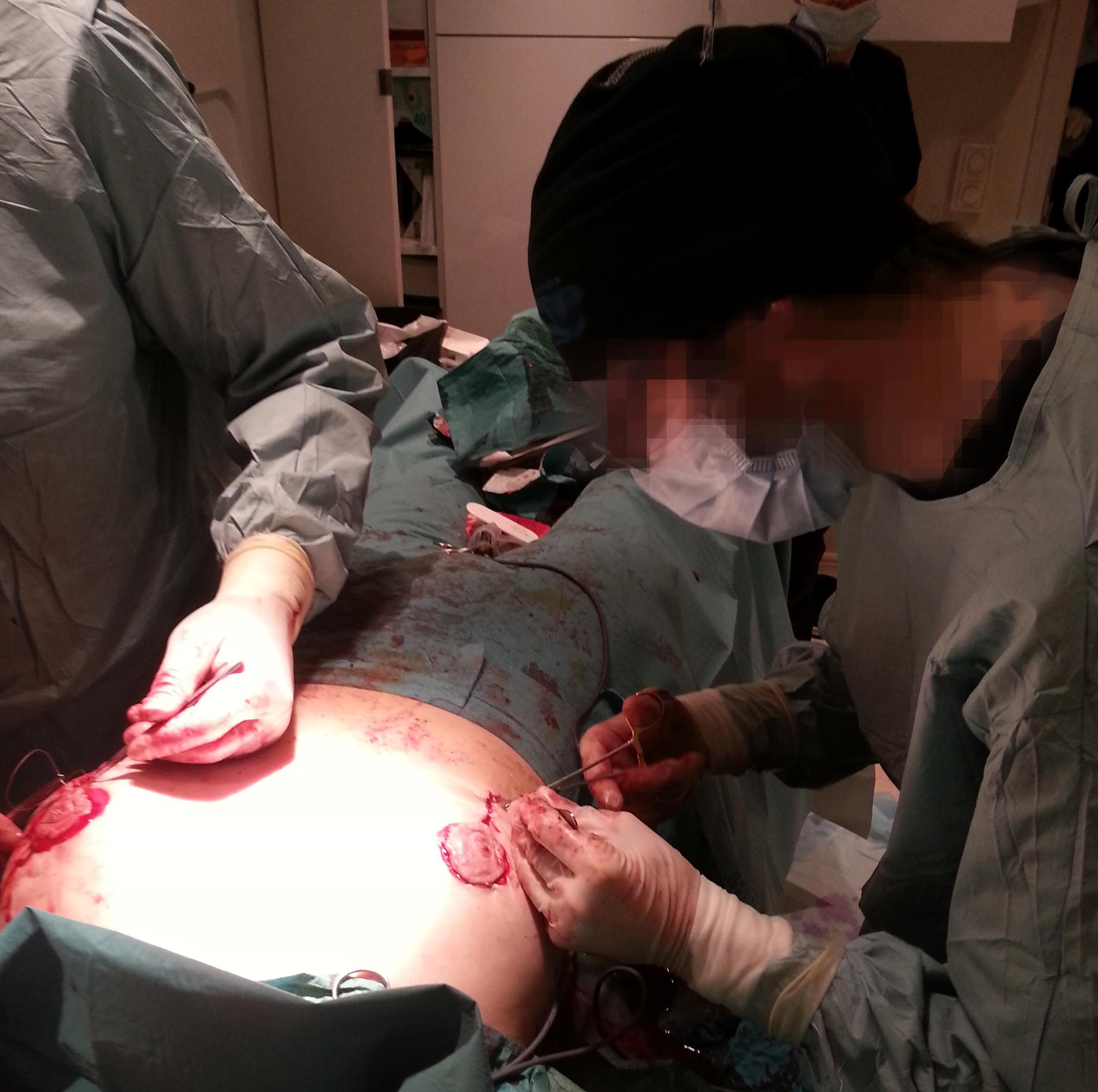 Här medverkar 38-åringen vid en bröstoperation. Enligt narkosläkaren som var med, så syr 38-åringen fast bröstvårtan på höger sida.
38-åringen själv förnekar att han ska ha opererat: ”Det här är förtal”.